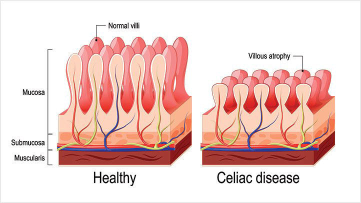Celiac-Disease-Villi